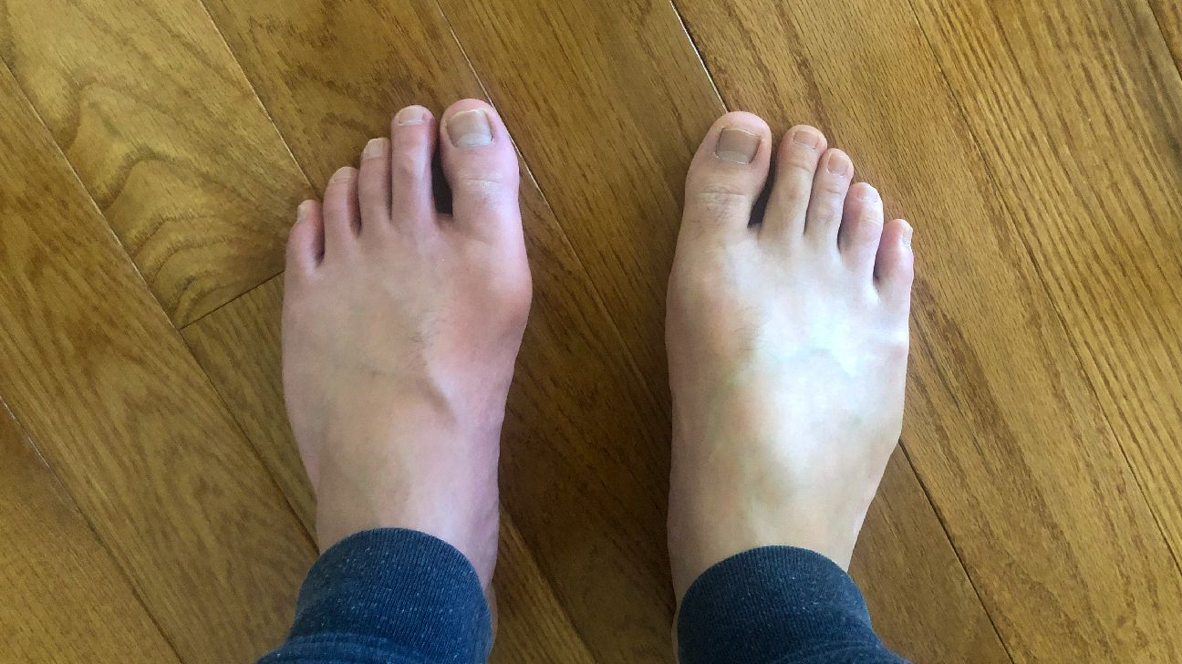 痛风的疾病概述与定义