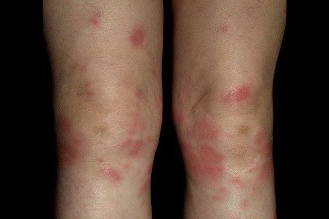 结节病的病理生理机制