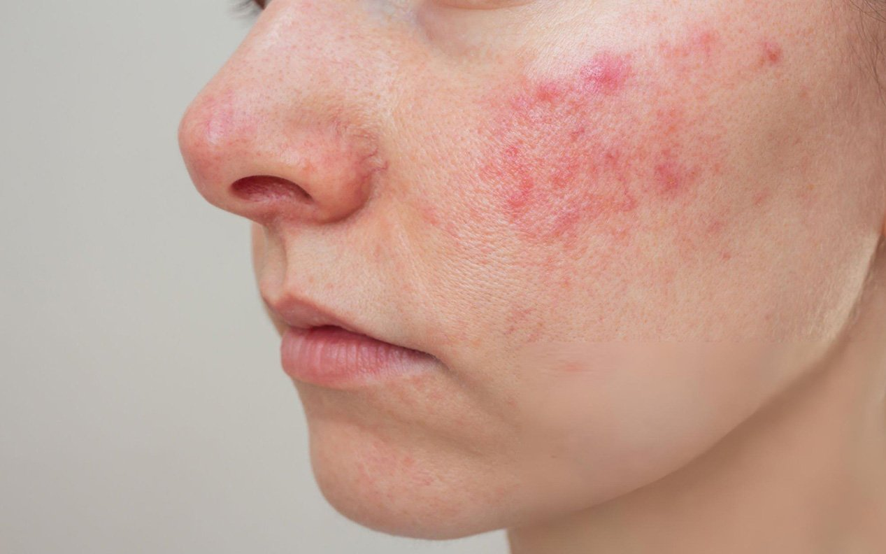 系统性红斑狼疮的临床表现与症状