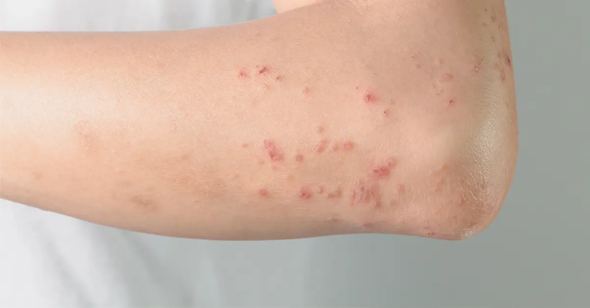 荨麻疹的临床表现与症状