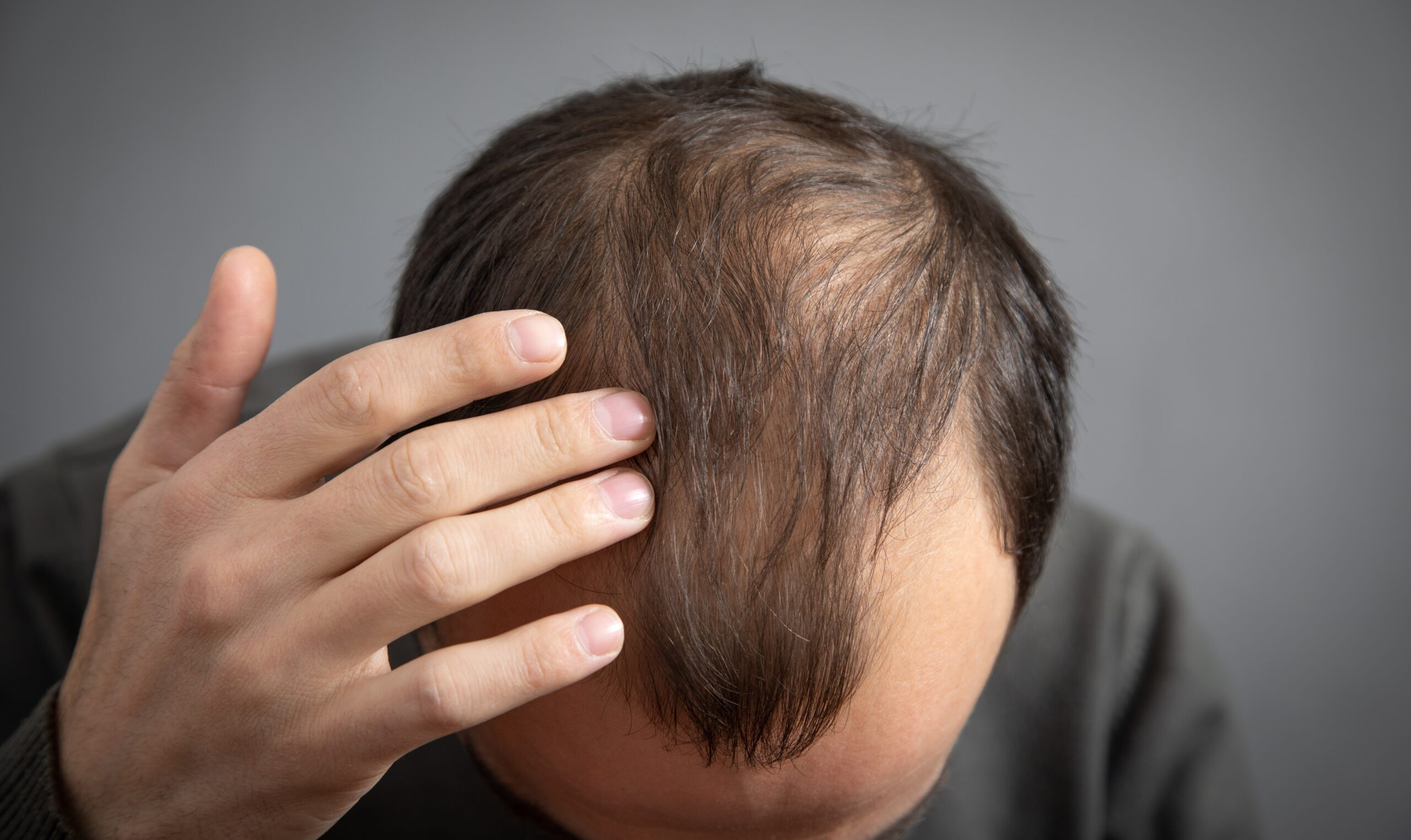 脱发的临床表现与症状