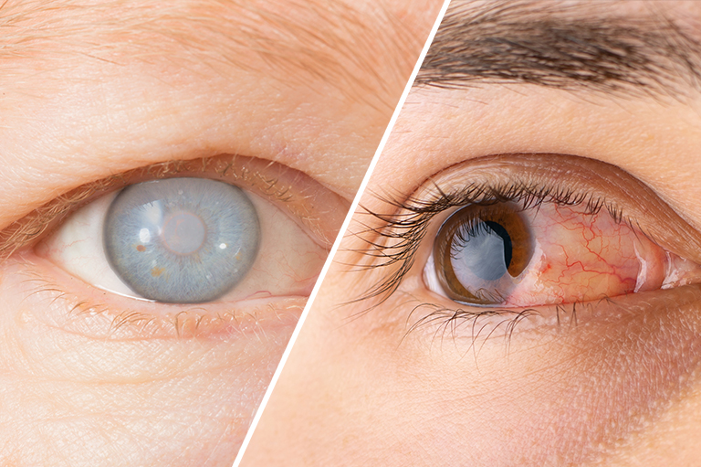 白内障的临床表现与症状