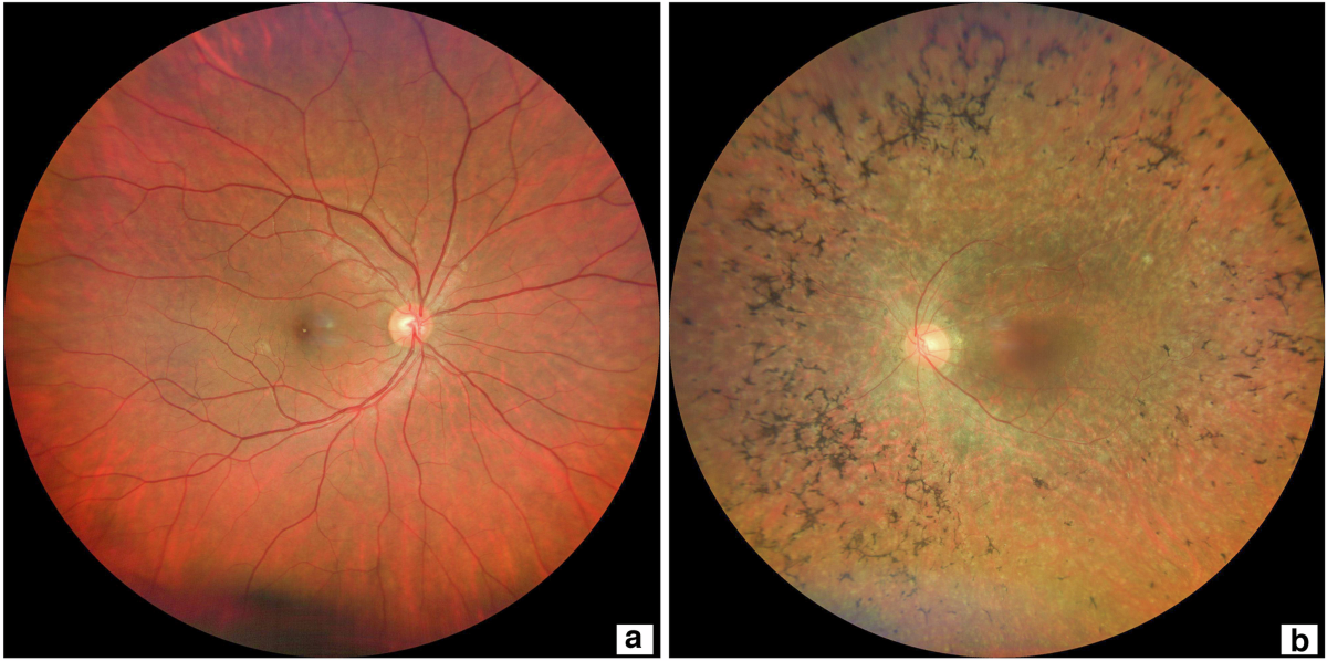 视网膜色素变性的临床表现与症状