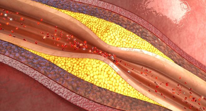 血管年轻计划:动脉粥样硬化颈动脉超声报告解读与营养逆转指南