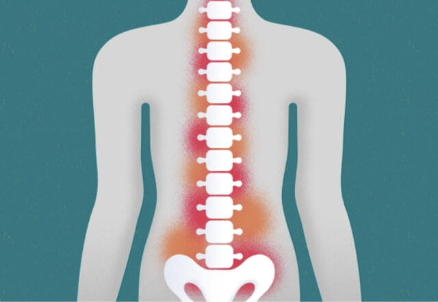 “钢筋水泥”僵直人生：深入解读强直性脊柱炎的早期信号与关键误区