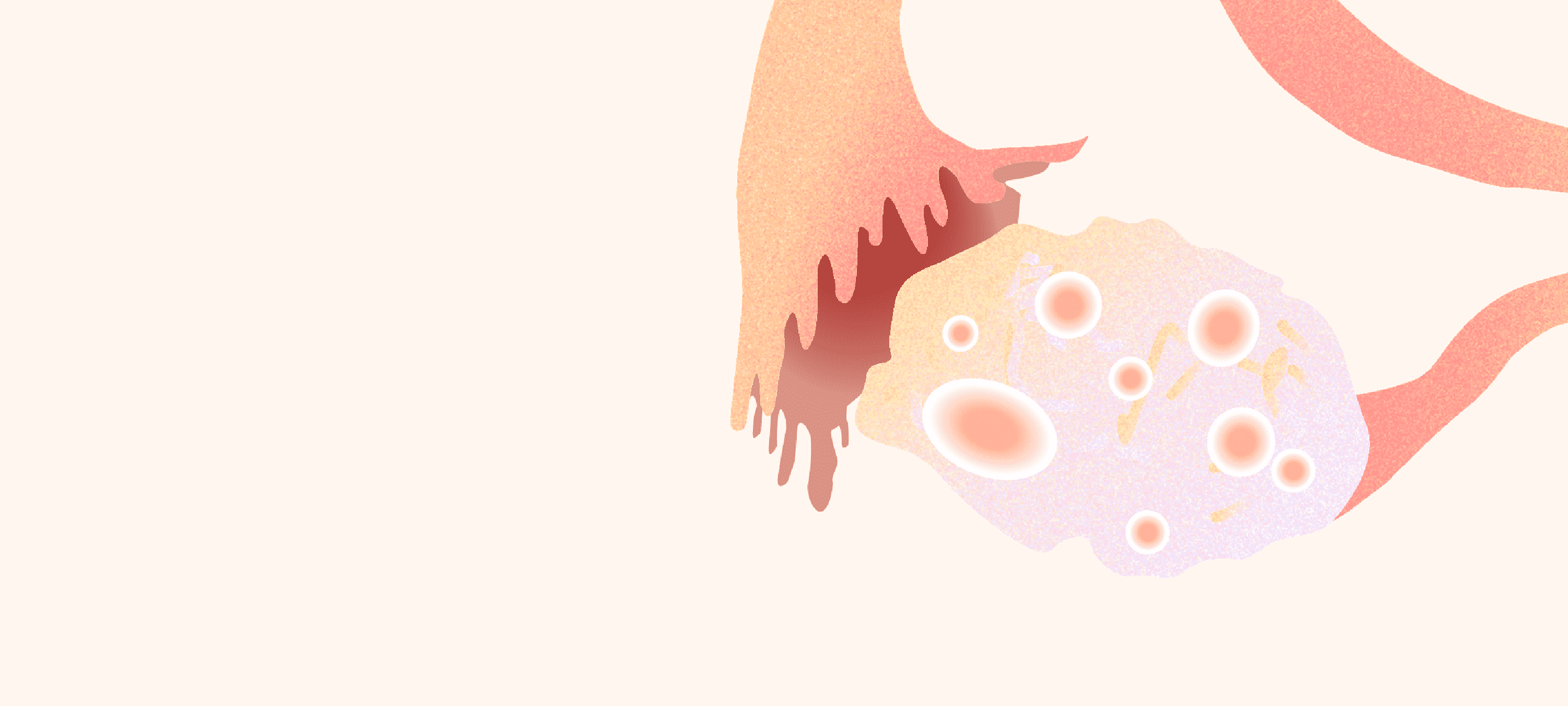 多囊卵巢综合征的临床表现与症状