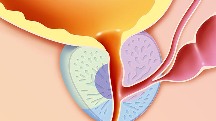 前列腺炎的临床表现与症状