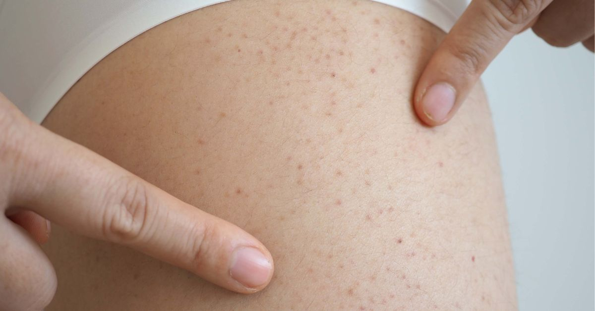 血小板减少症的长期管理与预防复发