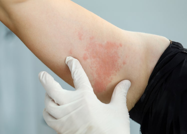 深度应对红斑狼疮(SLE):自身抗体报告解读与系统免疫调节干预