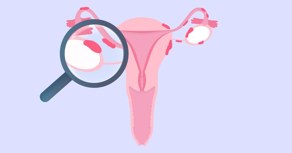 缓解痛经与不孕：子宫内膜异位症的CA125、影像学报告解读与药物、手术干预