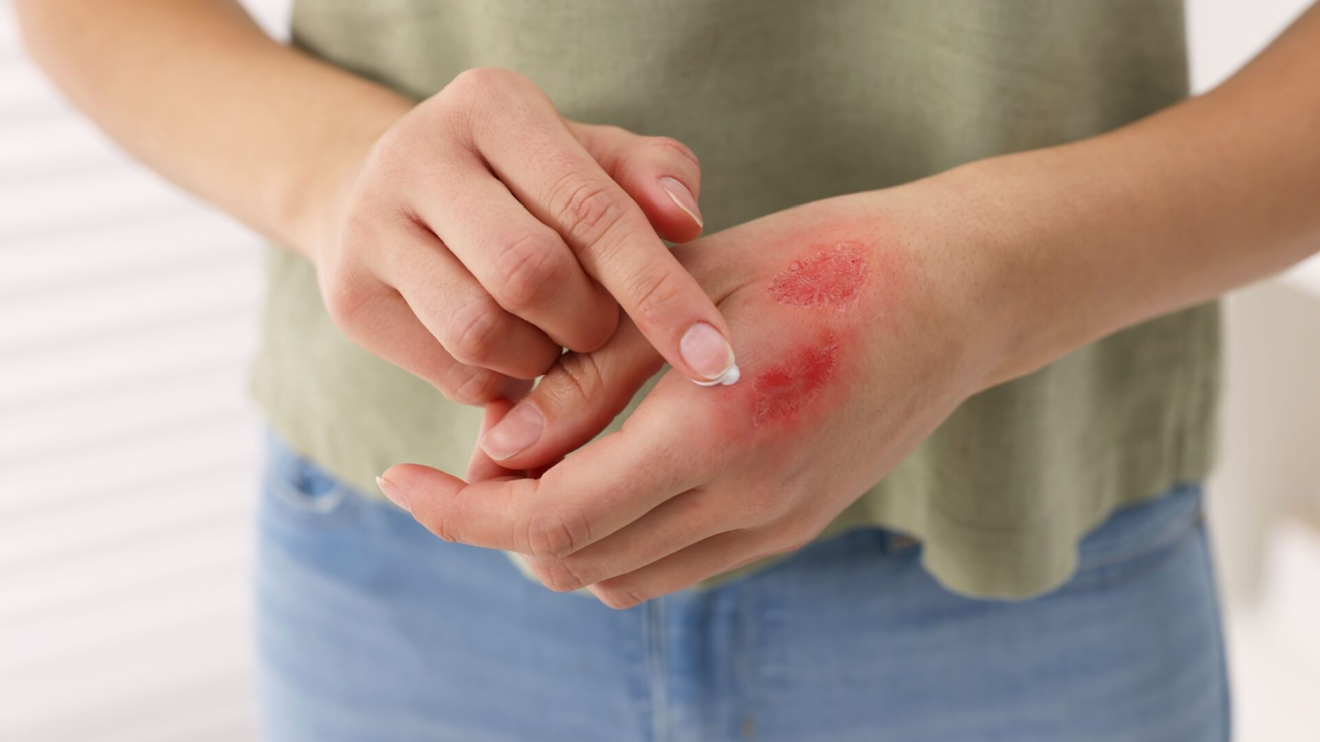 烧伤急救与液体复苏：烧伤面积与深度报告解读与液体复苏、感染预防