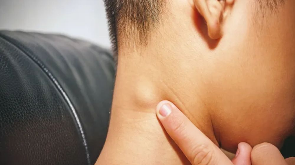 淋巴瘤的长期管理与预防复发